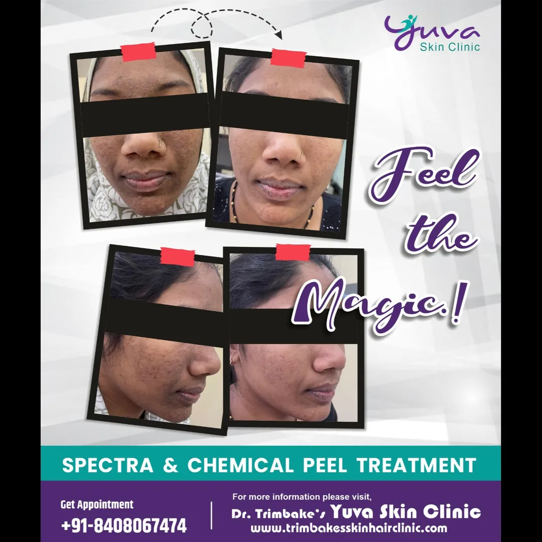 Feel the magic..
When it comes to refreshing your skin, chemical peel and spectra laser are two of t...