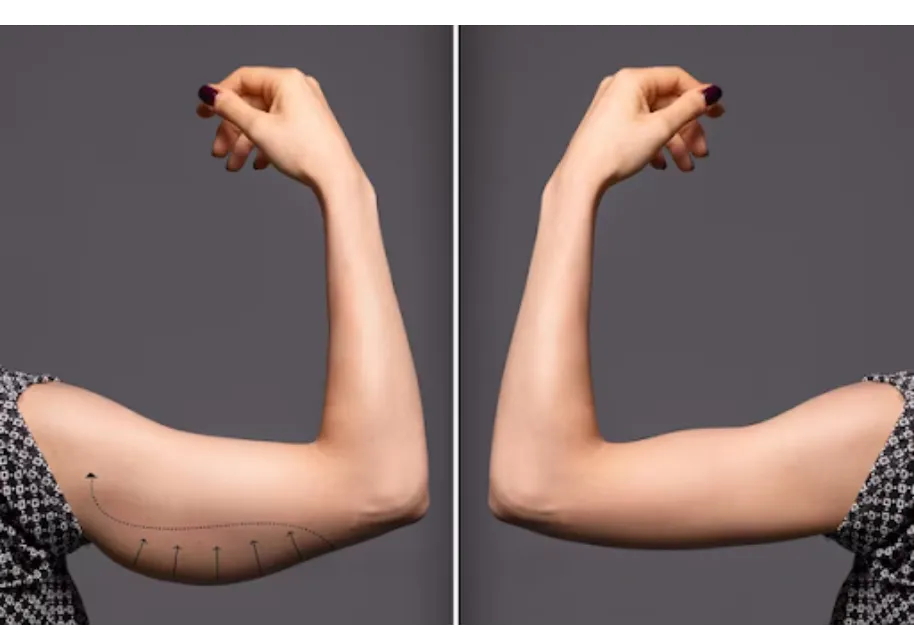Arms Lift in Bangalore – Restore Youthful Upper Limbs