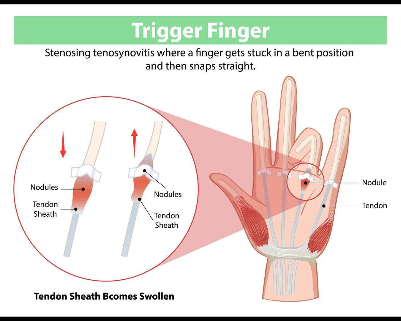 Relieve Pain with Trigger Finger Treatment in Mumbai – Get Your Fingers Moving Again