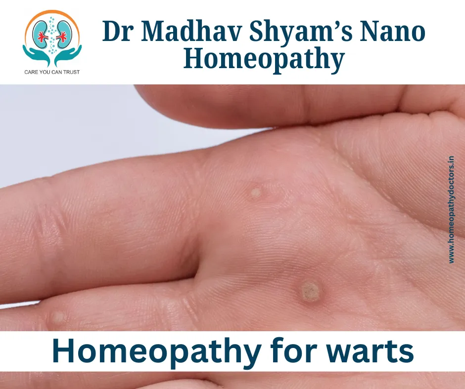 Homeopathy treatment for warts