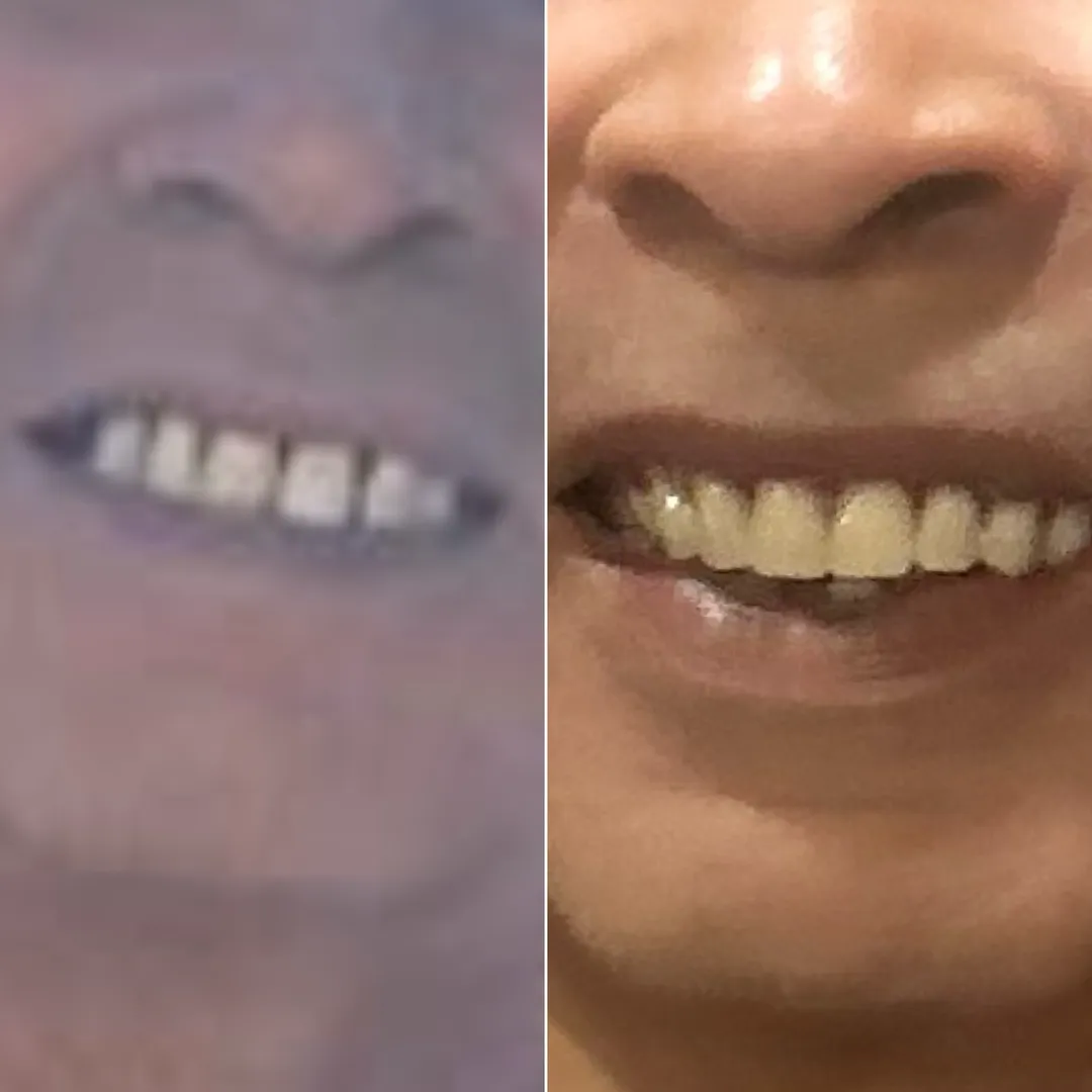 š¦·āØ IMMEDIATE DENTURES @ ORCHARDS DENTAL ā WHEN LIFE DEMANDS TEETH NOW, NOT LATER! š