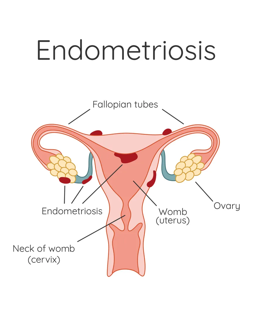 Endometriosis Doctors in Thane – Helping Women Find Relief and Clarity