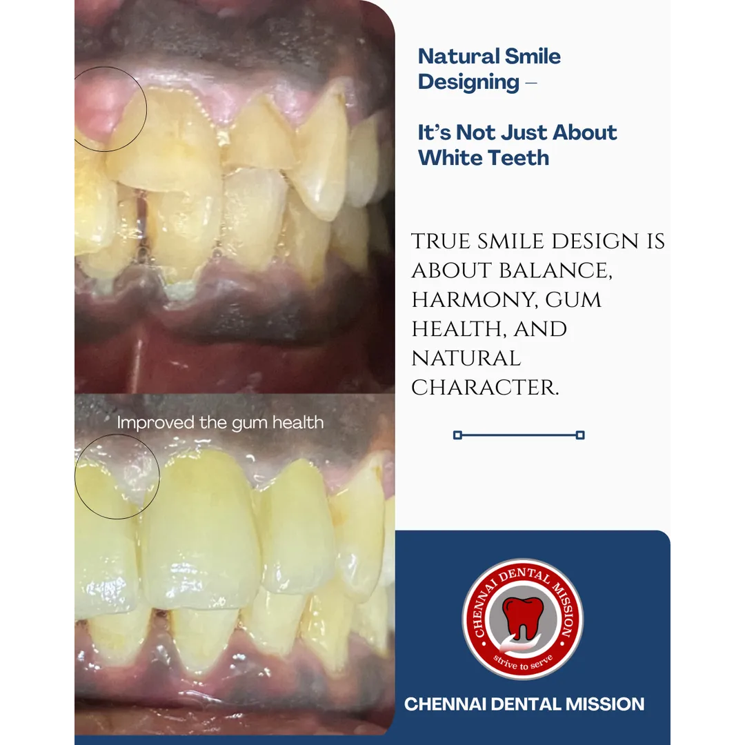 Natural Smile Designing – It’s Not Just About White Teeth
