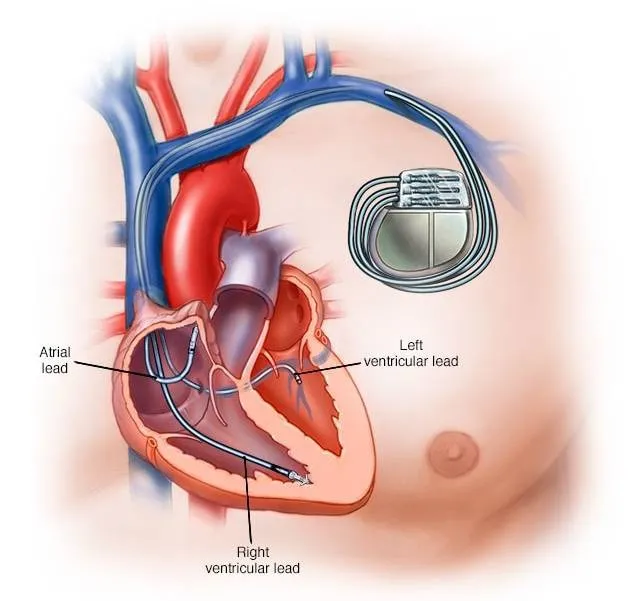 Pacemaker Care in Pune: Living Life Comfortably After Treatment