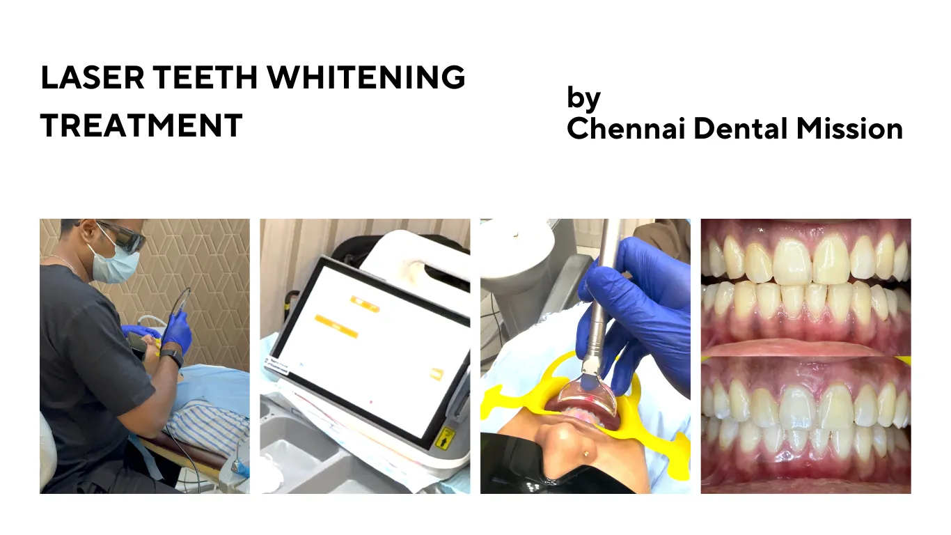 Laser Teeth Whitening Treatment in Chennai Anna Nagar Best Dental Clinic