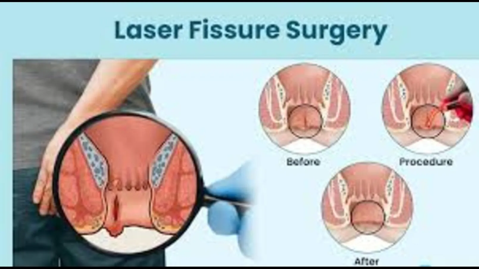 Fissure Treatment in Mumbai – Quick Relief through Expert Care