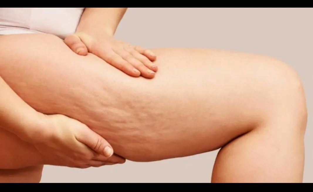 Best Dermatologists for Cellulite in Dhule | Gindodia Hospital