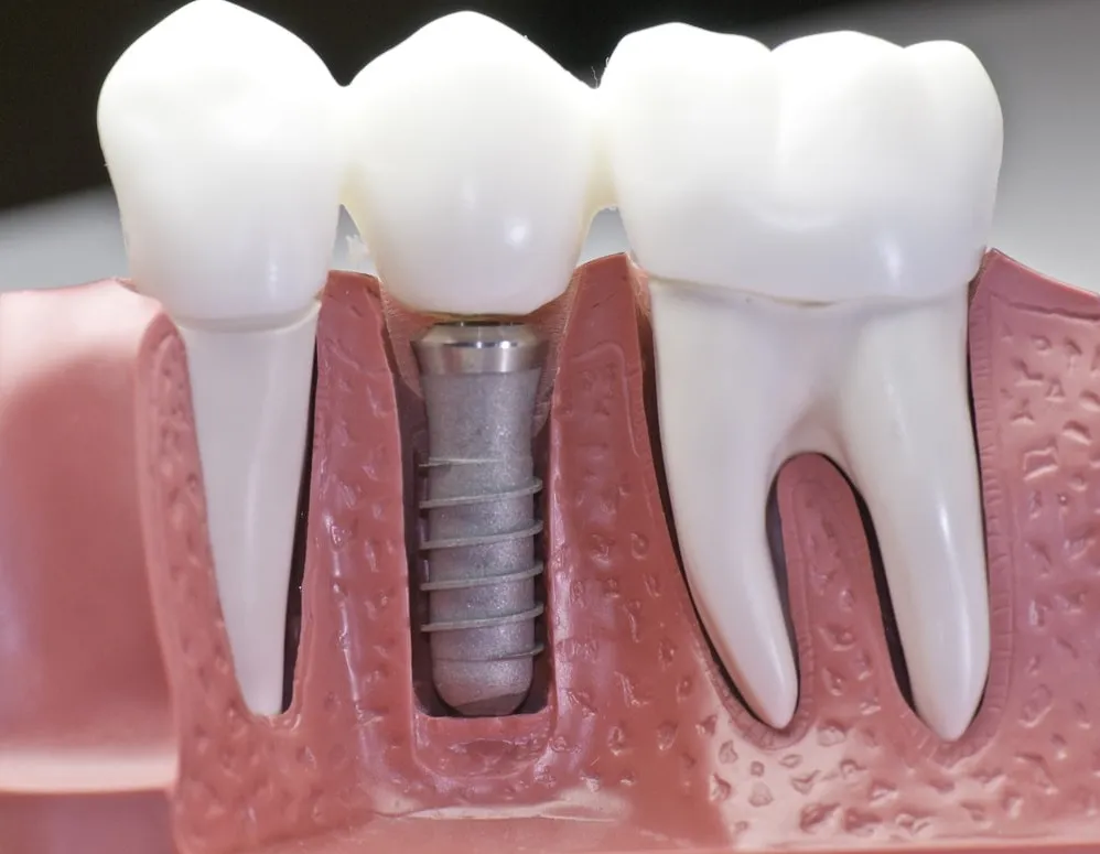 Best Implant surgery in vashi