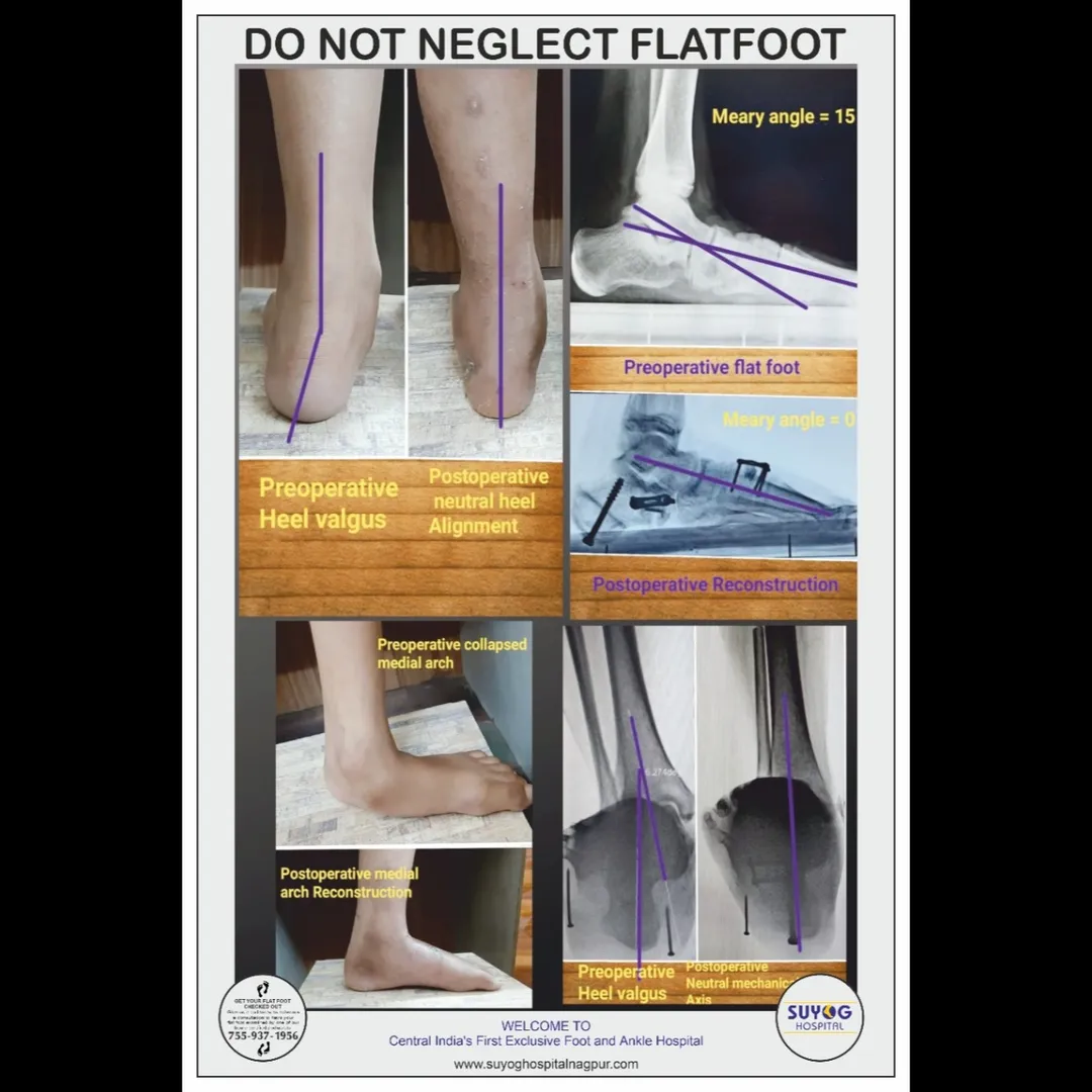 Advanced Orthopedic Treatment in Nagpur – Complete Care for Joint, Bone, Foot & Ankle Conditions.