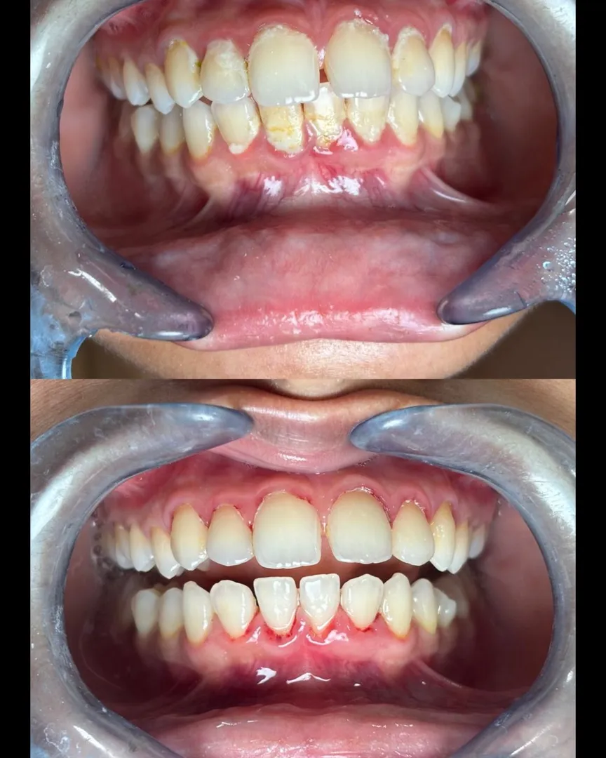 Why Regular Teeth Cleaning Is Essential for Mumbai Residents