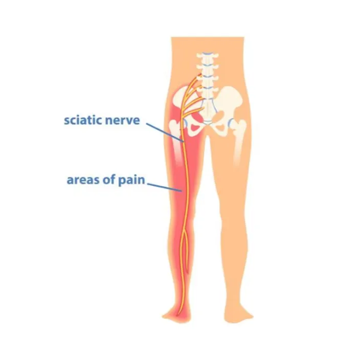 Sciatica Treatment in Noida – Regain Movement Without Persistent Pain
