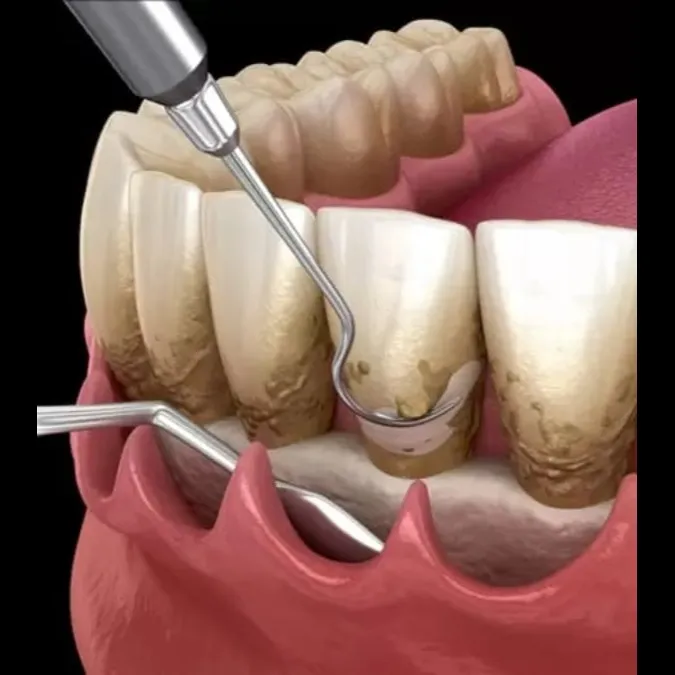 Best Full Mouth Flap surgery treatment In koperkherne