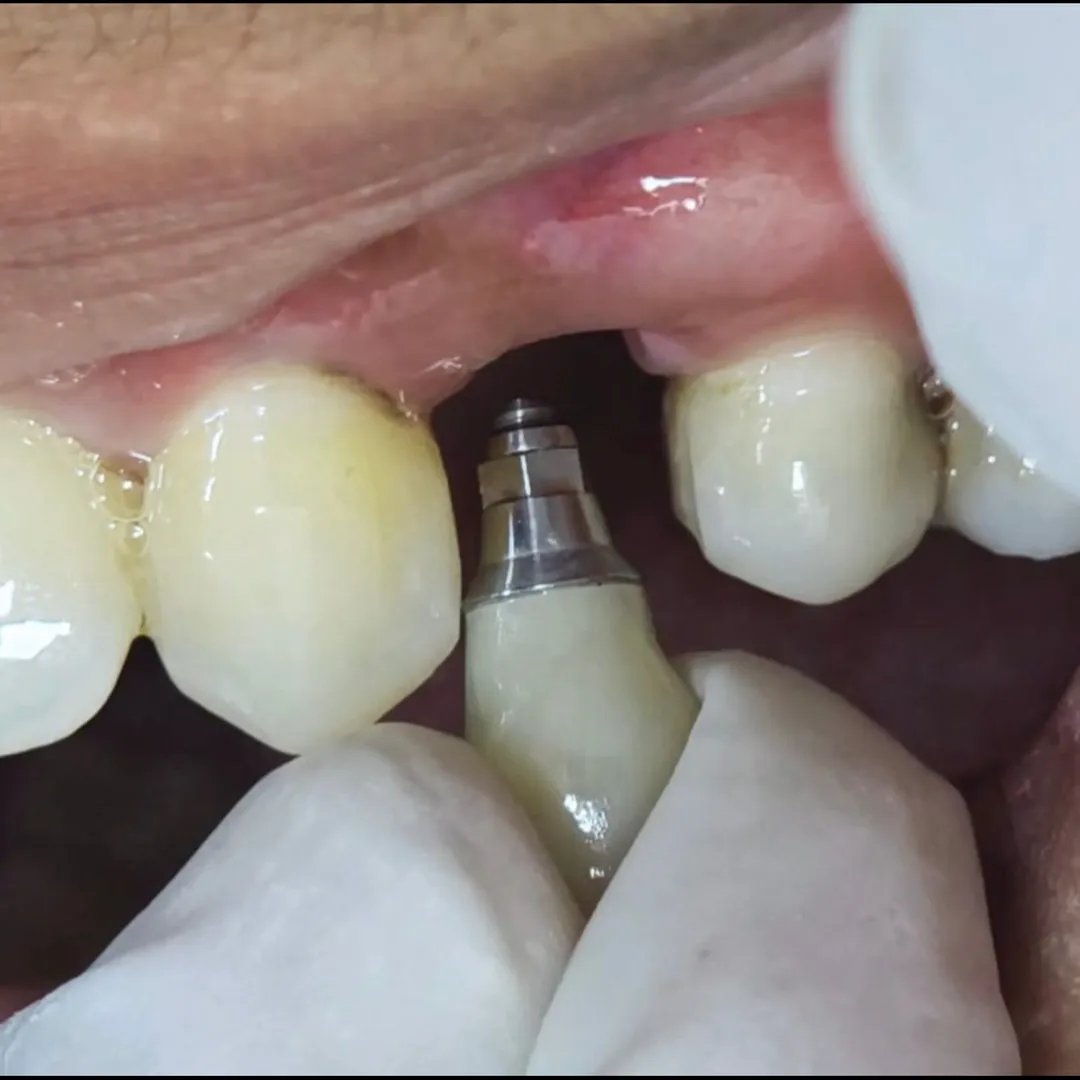 Is Dental Implant Surgery Painful? Honest Answers for Patients