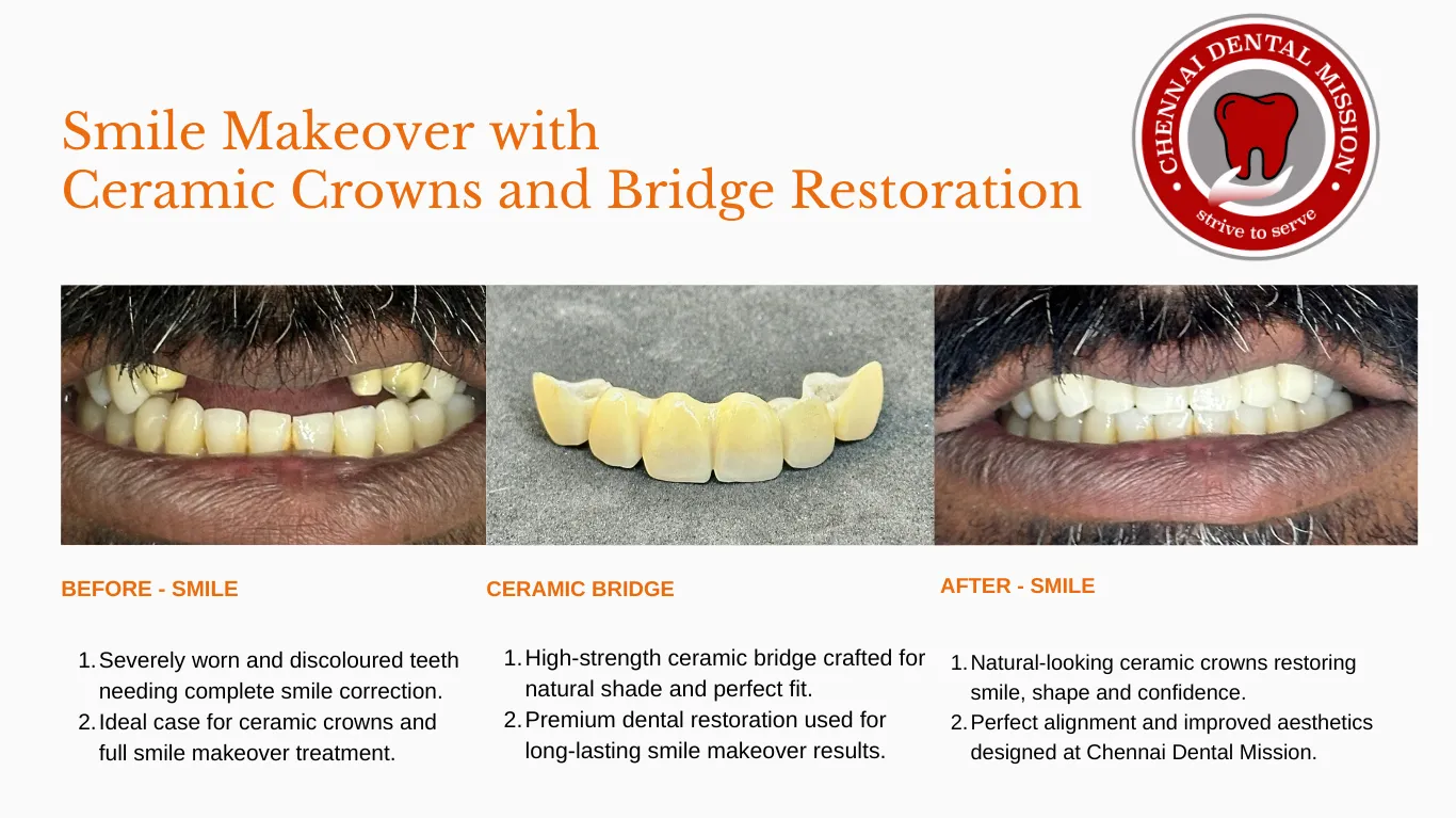 Smile Makeover with Ceramic Crowns and Bridge Restoration at Chennai Dental Mission Anna Nagar