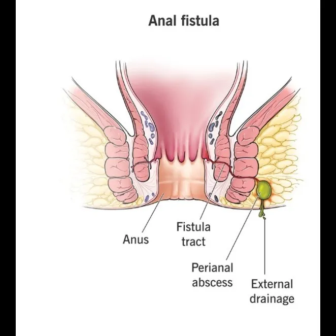 Fistula Treatment in Mumbai – Advanced Surgical Techniques for Lasting Results