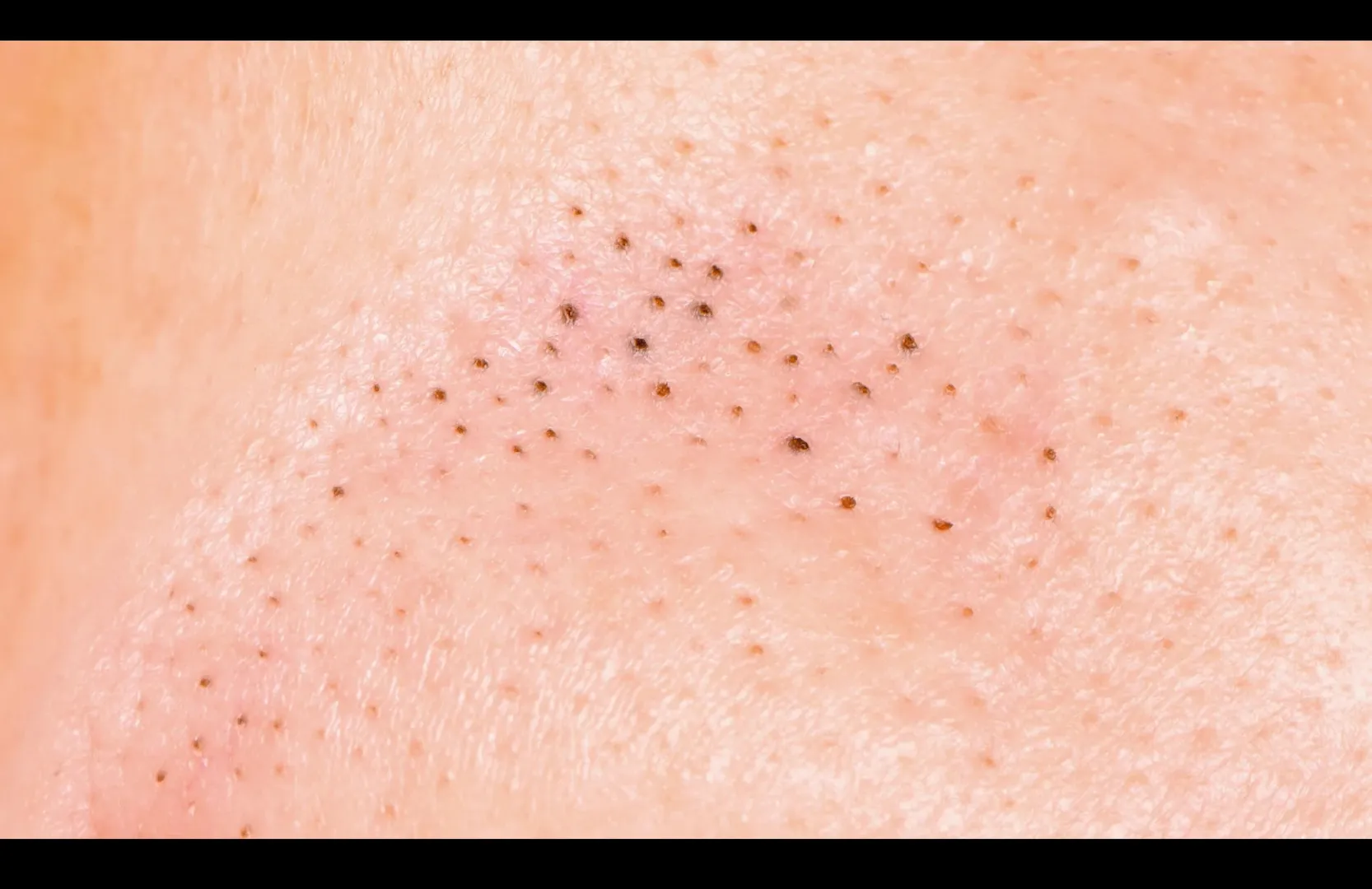 Gindodia Hospital | Best Blackheads Treatment in Dhule