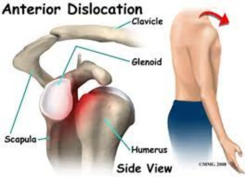 Shoulder Dislocation and Instability in Nagpur – Restoring Shoulder Strength