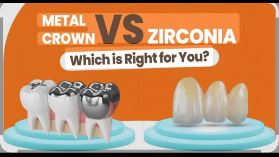 Zirconia Crowns vs Metal Crowns – Which Should You Choose?