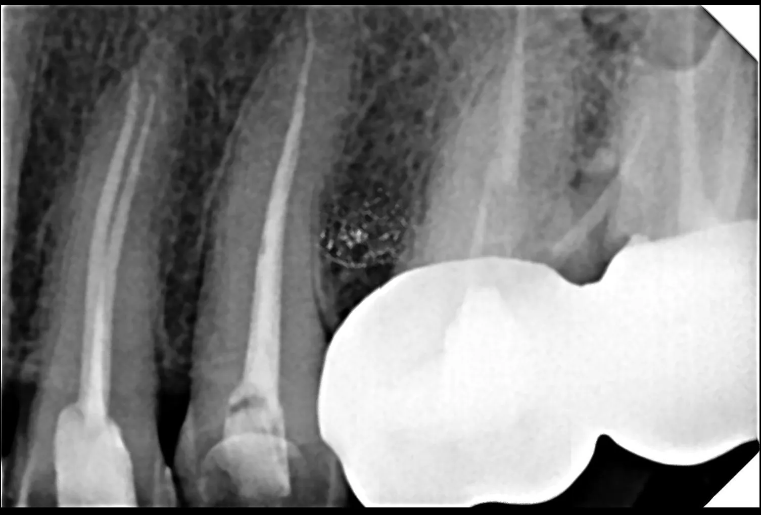 Is Root Canal Treatment Painful? Modern Reality vs Old Fear