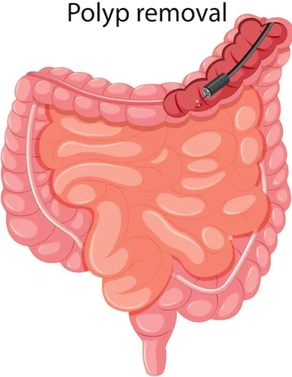 Colonic Polyps Evaluation in Mumbai