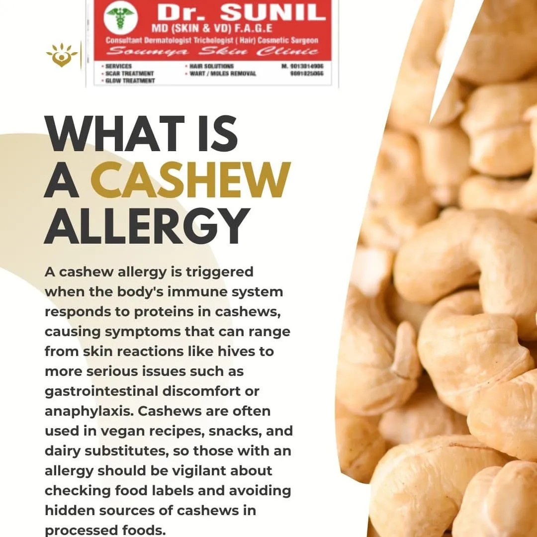 Cashew Allergy