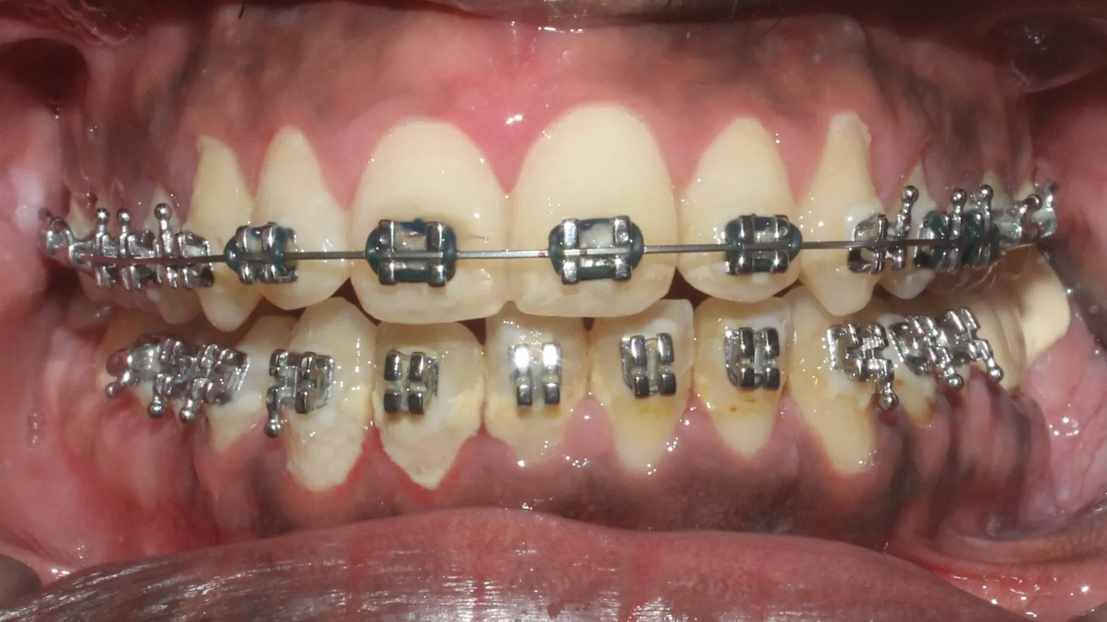 What Is the Right Age to Start Braces?