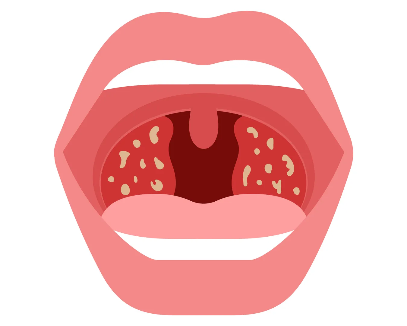 Coblation and Laser Tonsils and Adenoid Surgery in Nashik