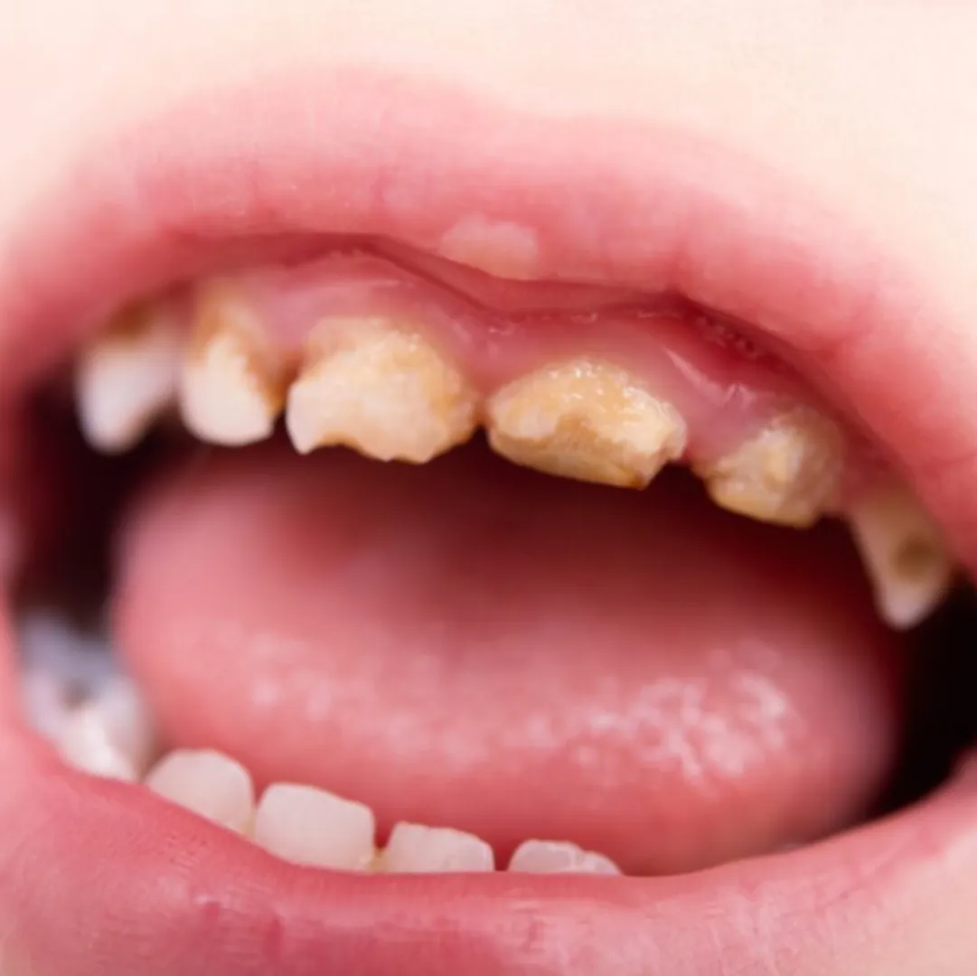 Caries in milk teeth in South Delhi