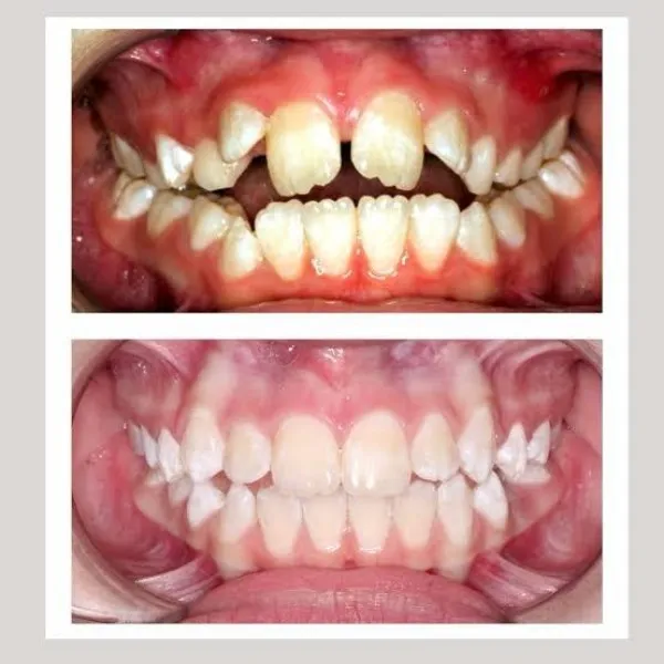 Perfect Your Smile with Teeth Alignment Treatment At Dr. Jain’s Multispeciality Dental Clinic, Nagpu