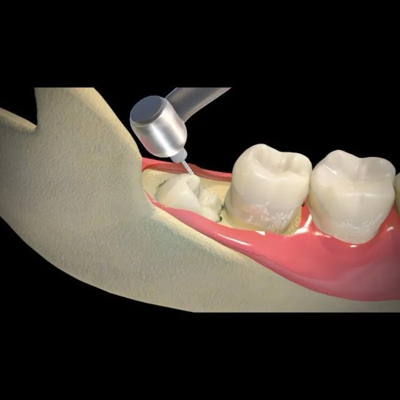 Safe & Expert Wisdom Tooth Removal At Dr. Jain’s Multispeciality Dental Clinic, Nagpur