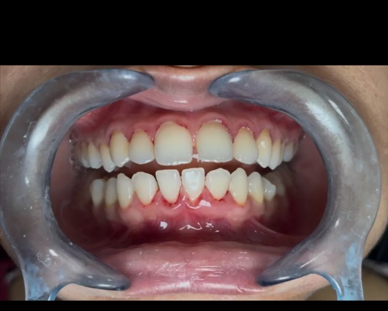 Gum Disease and Heart Health – Are They Linked?