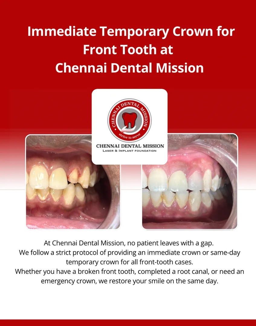 Immediate Crown for Front Tooth at Chennai Dental Mission