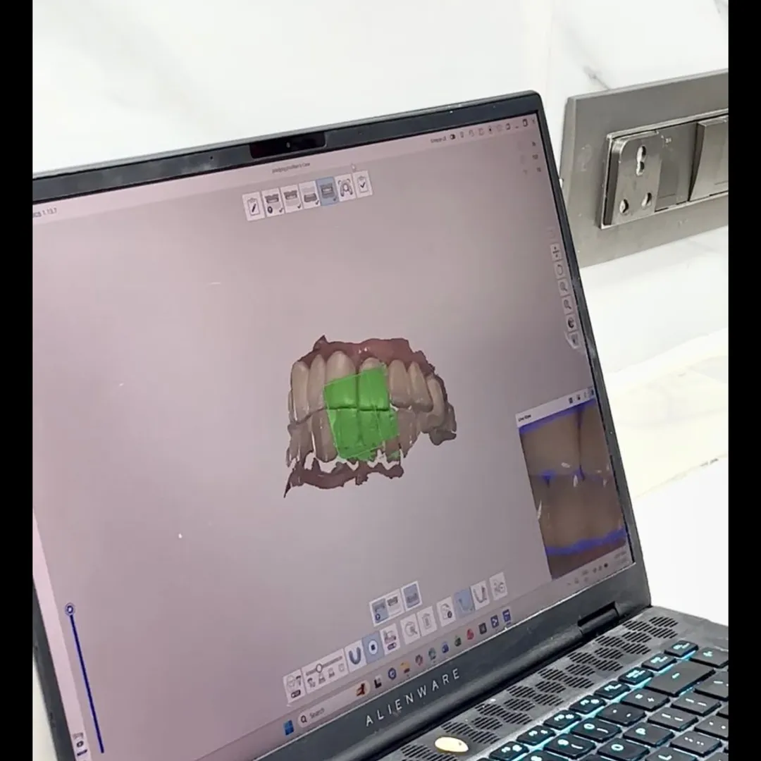3D Scanning for Crowns and Implants – No More Gooey Impressions