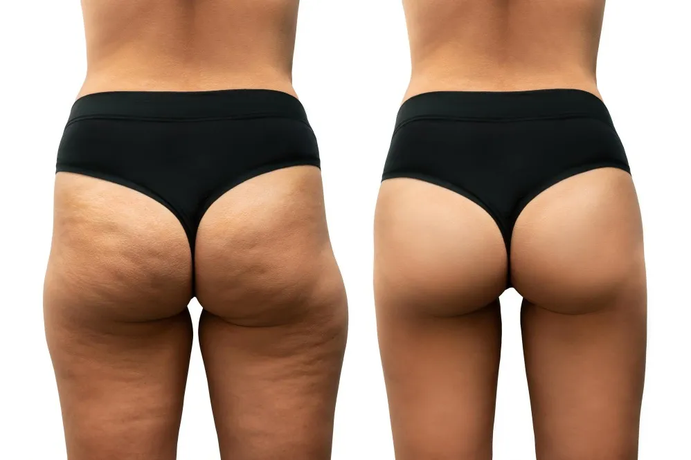 Buttock Lift in Bangalore – Elevate Your Curves