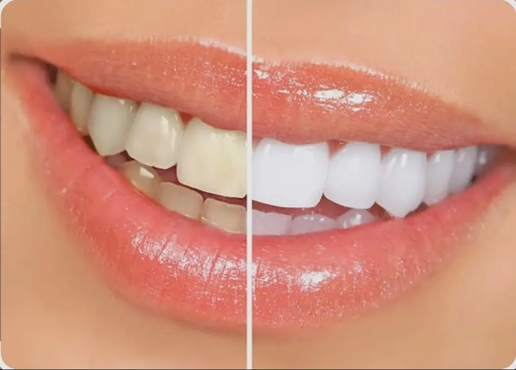 Best Teeth Whitening Options in Mumbai for a Brighter Smile