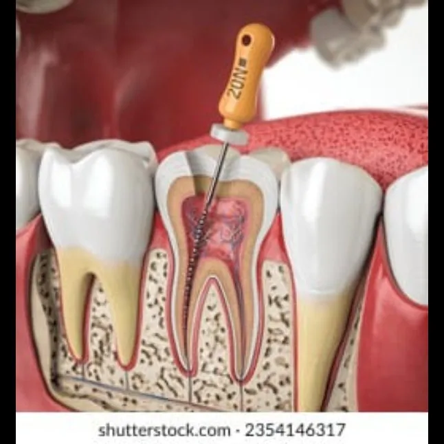 Best Root Canal Treatment In Ghansoli