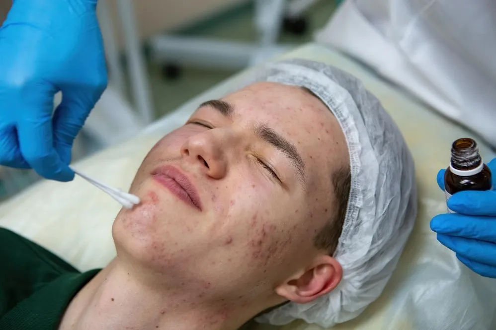 Advanced Acne Scar Removal Treatment in Adyar for Smooth, Refined Skin