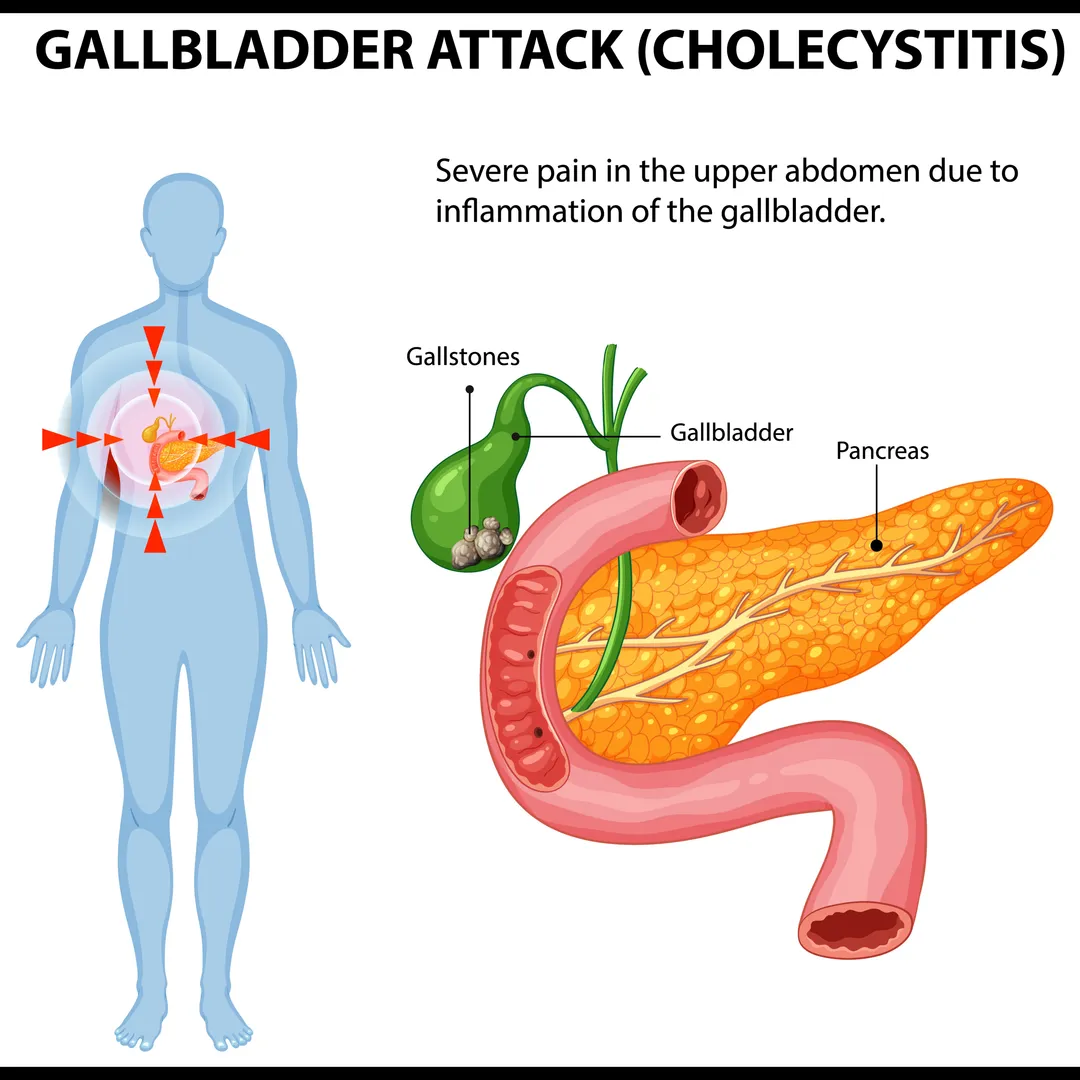 Cholecystitis Treatment in Mumbai – Modern Surgical Care for Faster Recovery
