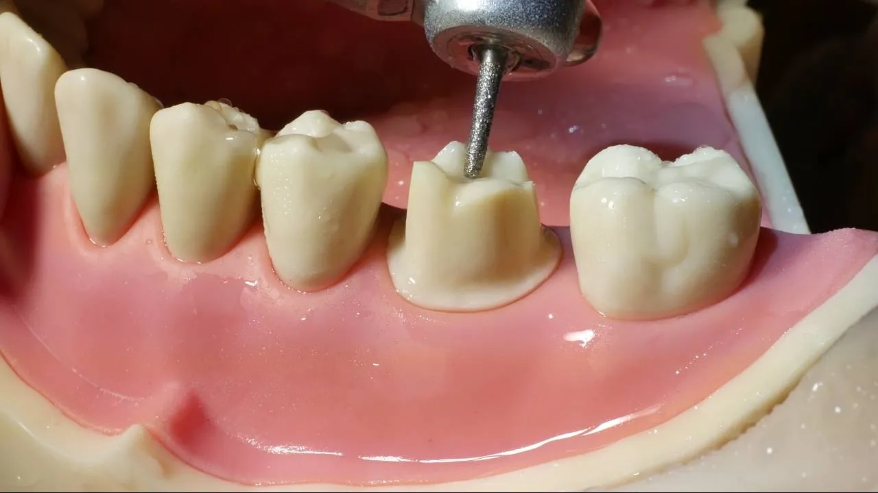 When Do You Really Need a Dental Crown?