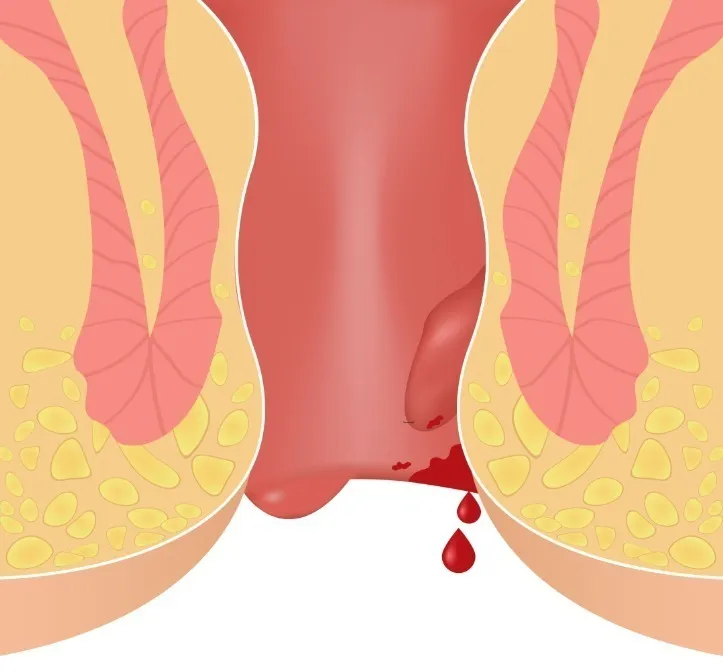 Piles Surgeon in Kolathur, Chennai