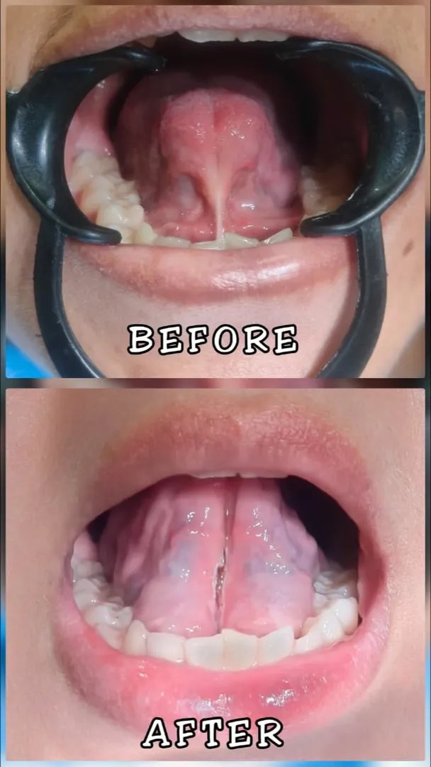 Goodbye Tongue Tie đź’› @ Orchards Dental Care