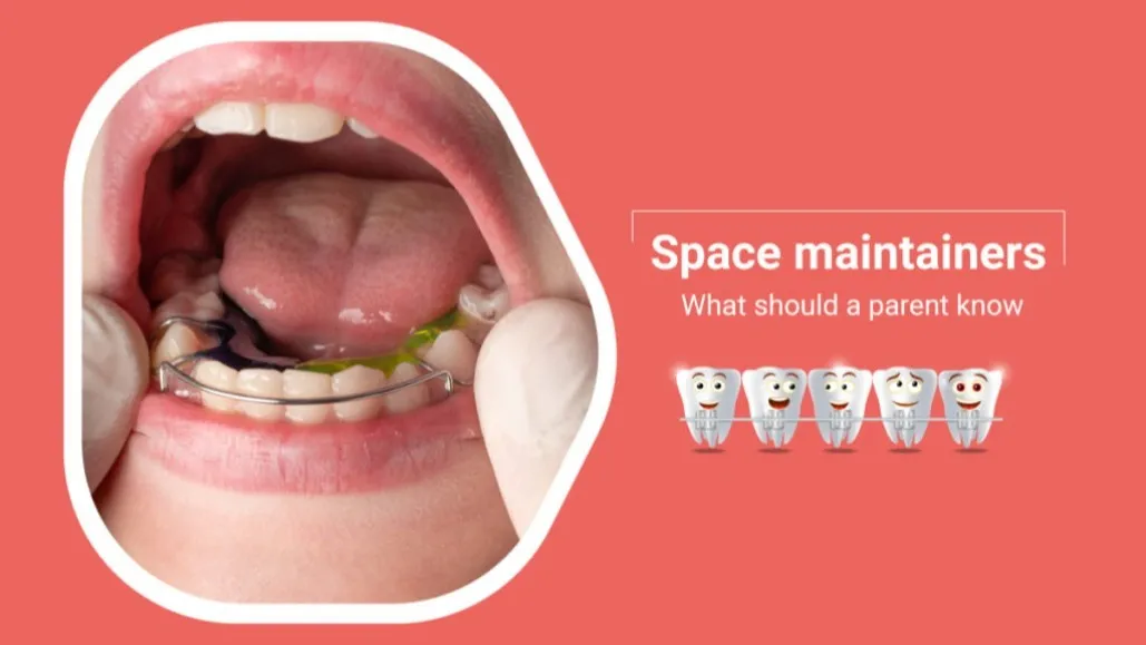 Pediatric Dentistry : Space Maintainers in Childrens Lajpat Nagar