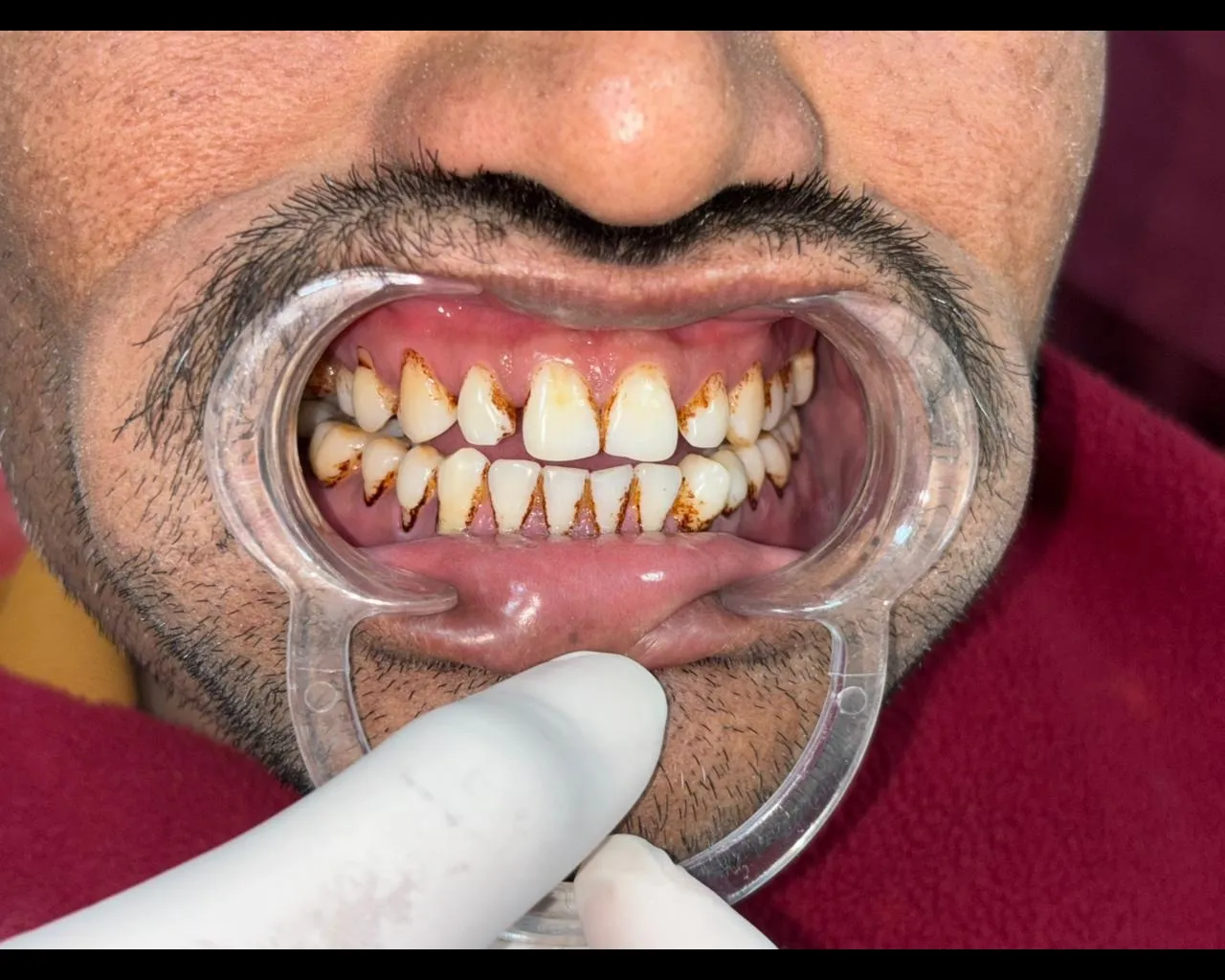 Bad Breath and Gum Infections β Understanding the Connection