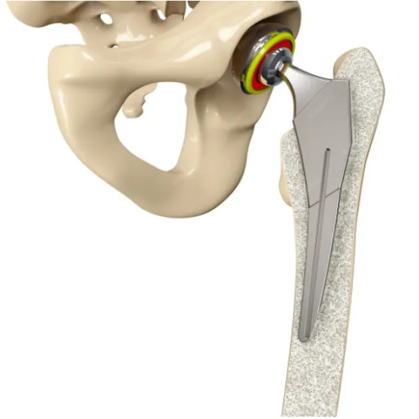 Revision Hip Replacement in Bangalore – A Second Chance at Pain-Free Mobility