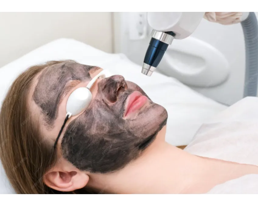 Carbon Laser Treatment in Nashik – Clear Skin in Just One Session