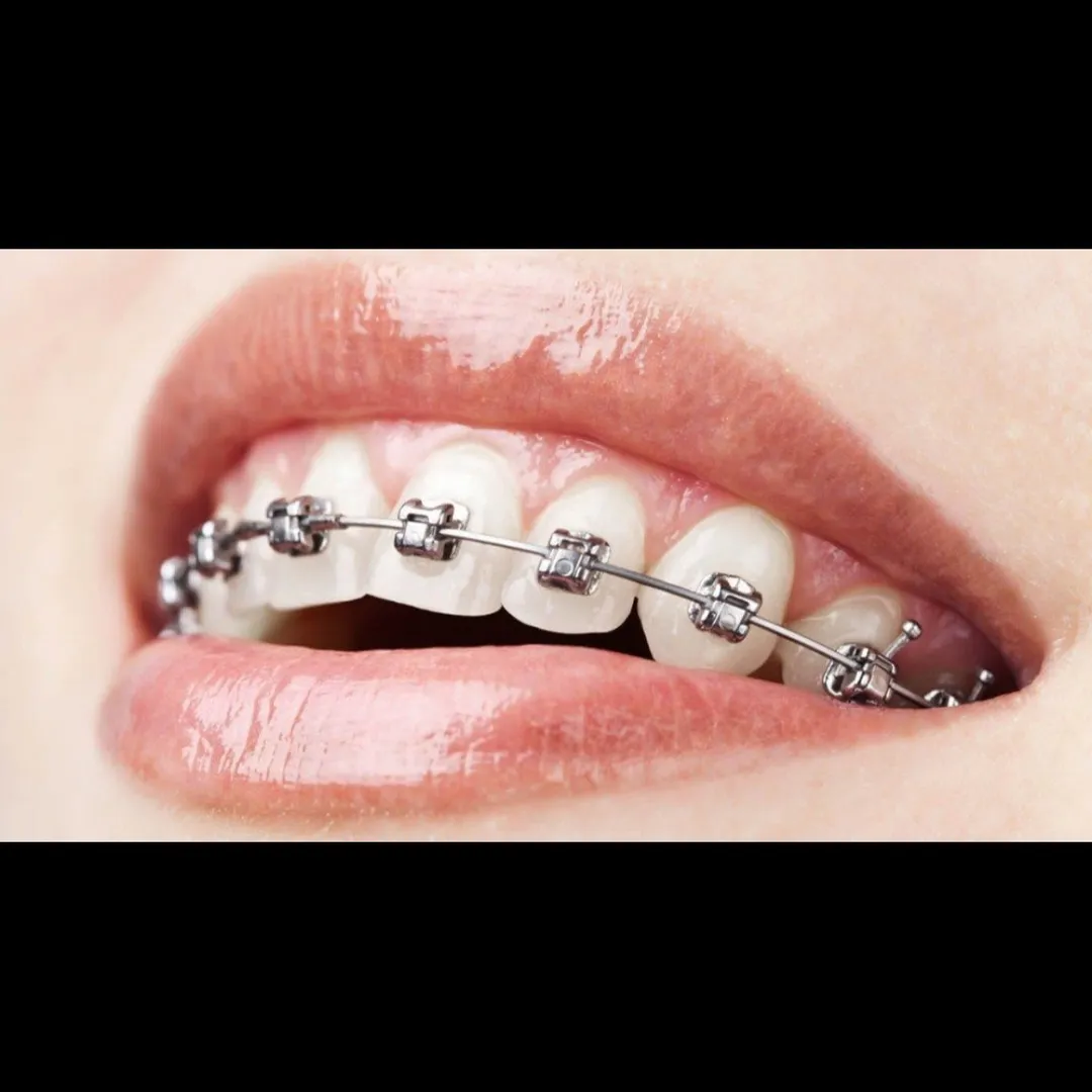 Best Braces treatment In vashi