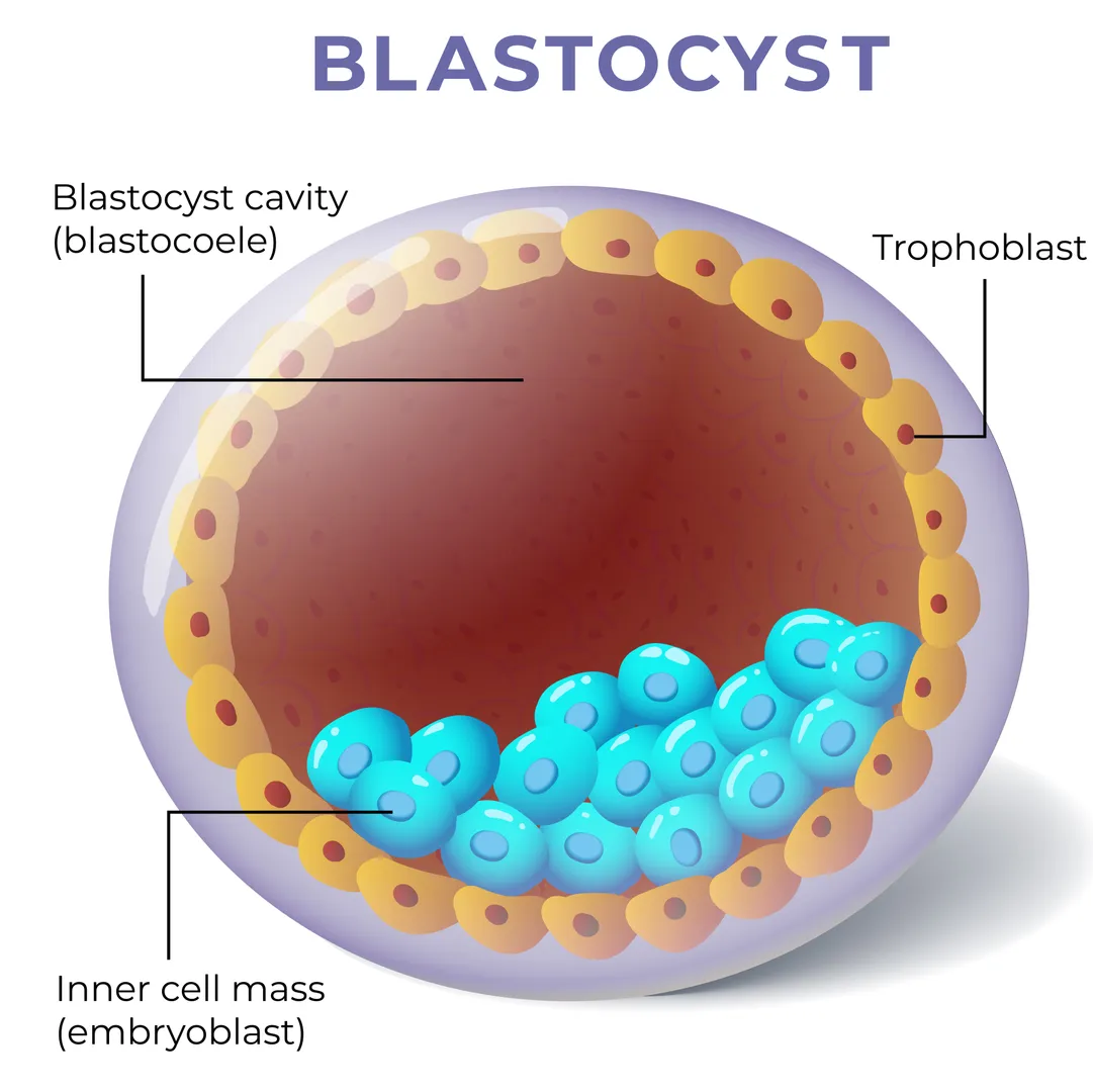 Blastocyst Transfer Procedure in Nashik – Optimize Fertility Success