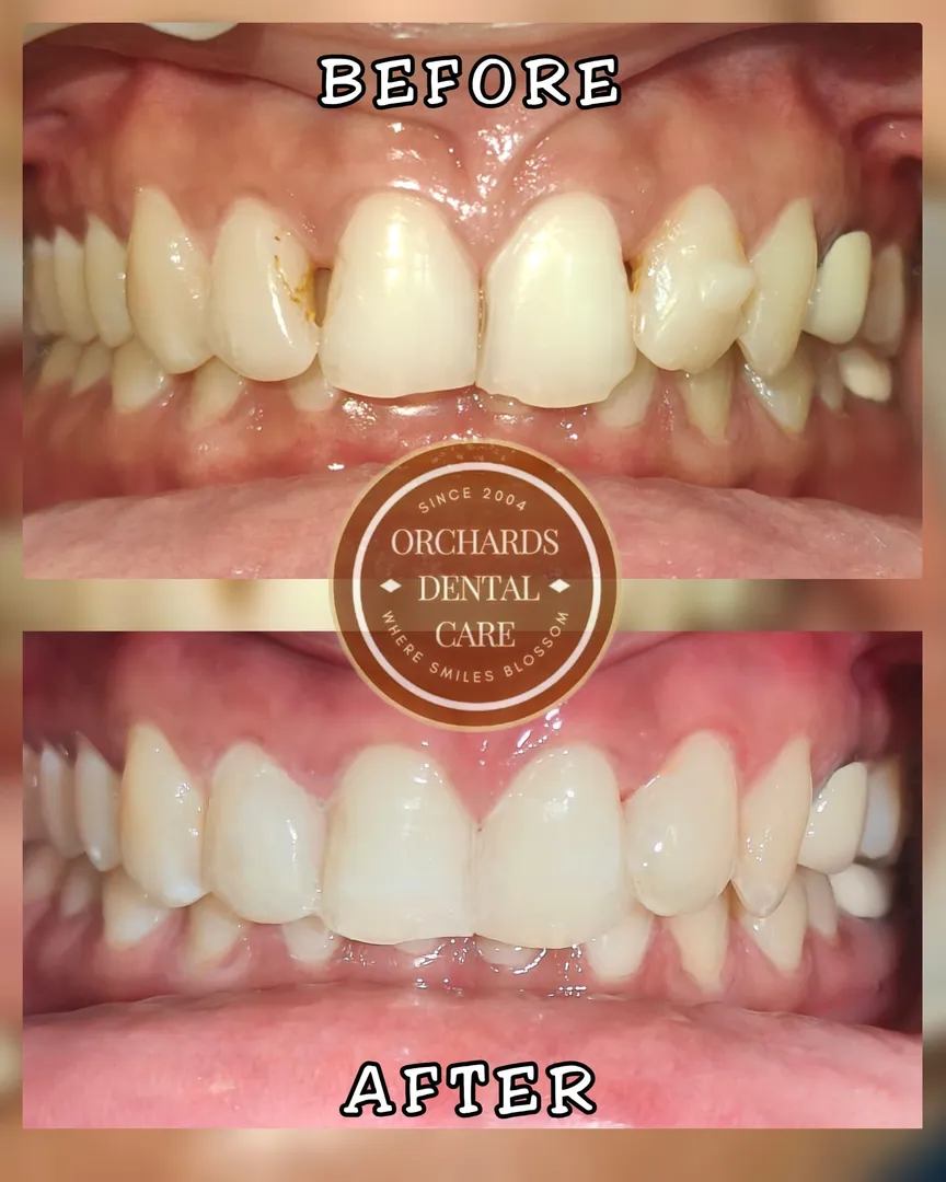 Closed the gaps, elevated the smile ✨🦷