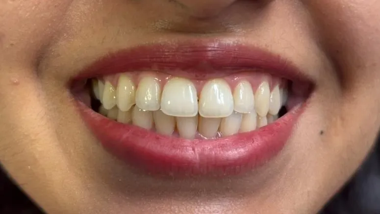 How Safe Is Professional Teeth Whitening at Procare Dental LLP?