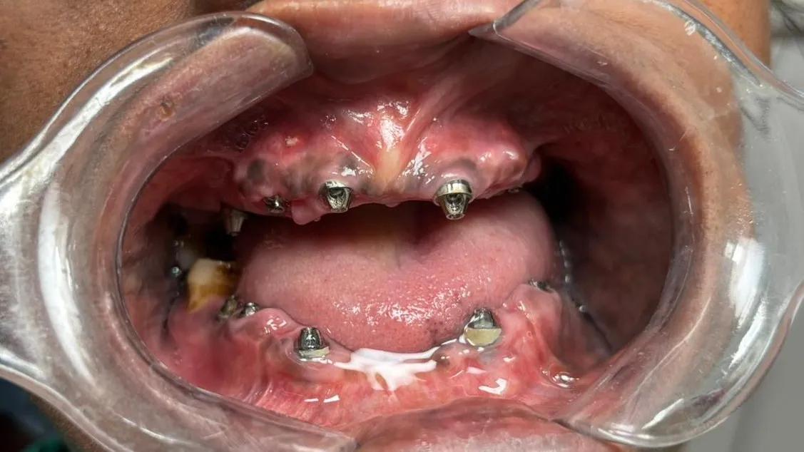 Full Mouth Implants in Mumbai – Who Is the